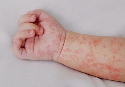 Vacunación contra el sarampión sí o sí